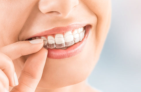 Invisalign Invisible braces at Health INspired Dentistry, Cleveland, Ohio