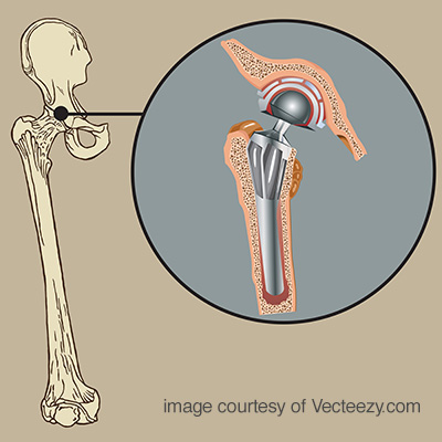 Cementless Arthroplasty Prosthesis