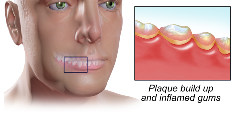 Gingivitis