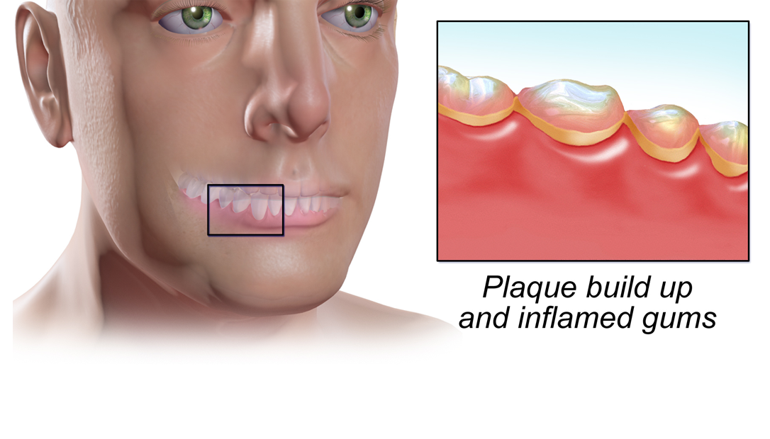 Gingivitis